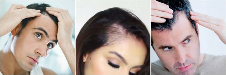 Alopecia