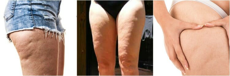 Celulitis