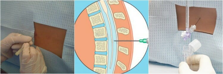 ¿La punción lumbar duele?