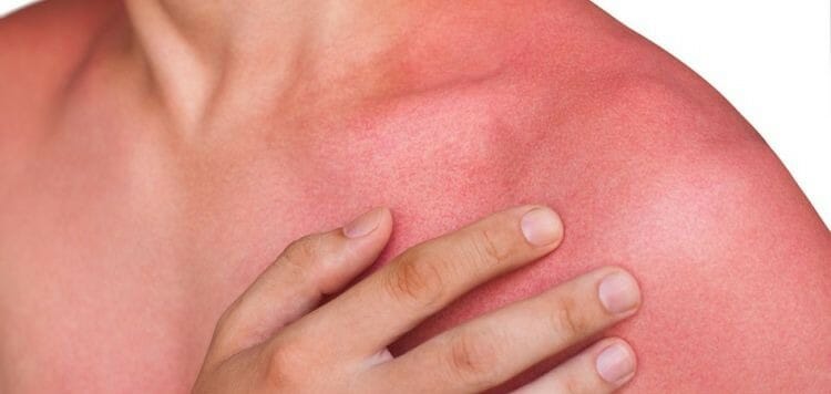 Grados de las quemaduras solares