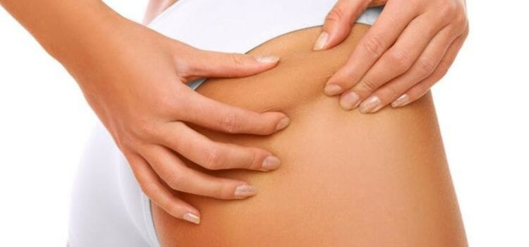 Tratamientos de la celulitis