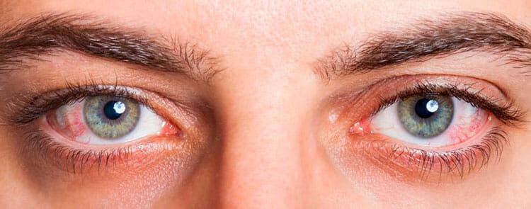 Conjuntivitis