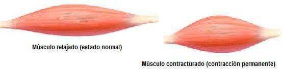 Contractura muscular