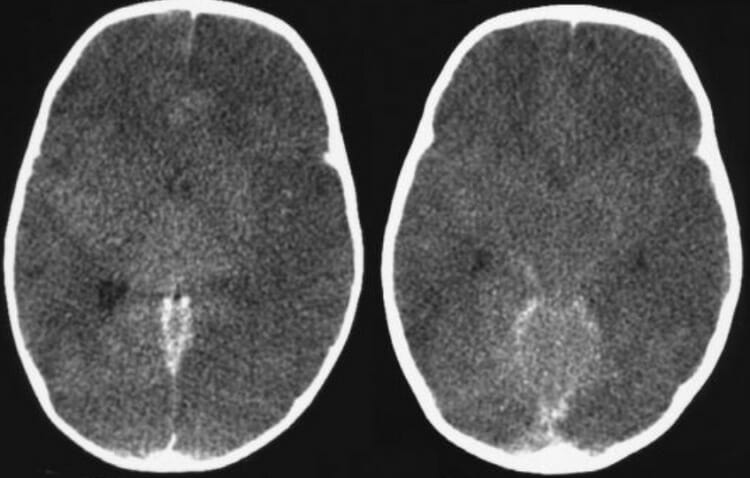 Tratamiento del edema cerebral
