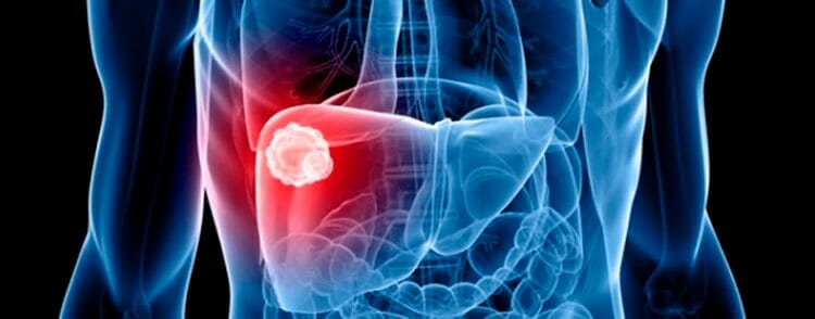 Hepatitis