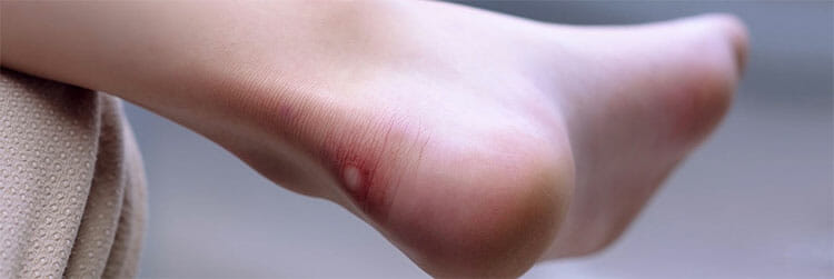 Ampollas en los pies