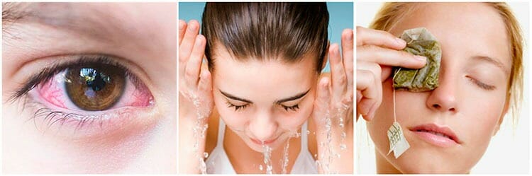 Remedios naturales para la conjuntivitis