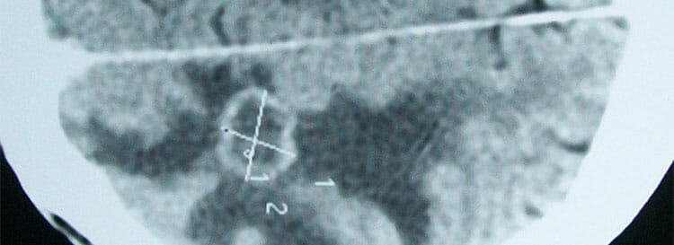 Tipos de edema cerebral