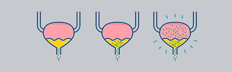 Tipos de infección de orina