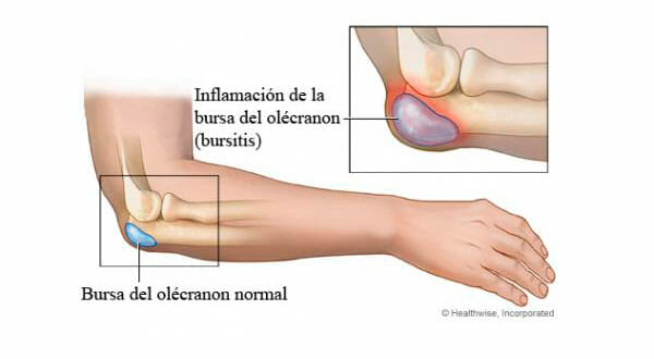 Qué es la bursitis