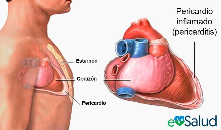 Causas de la pericarditis