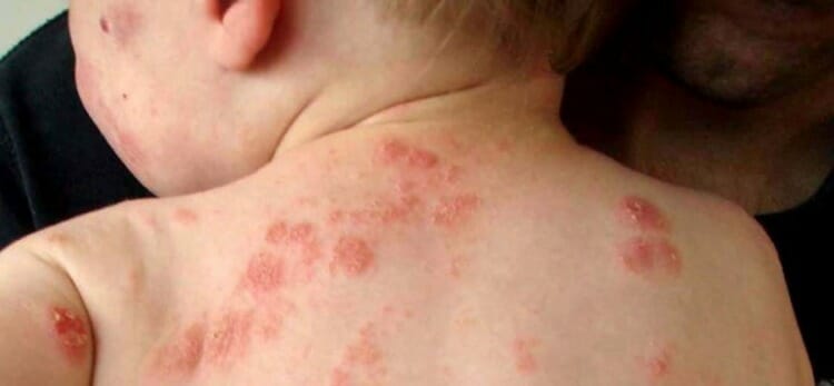 ¿Cómo prevenir el eccema?