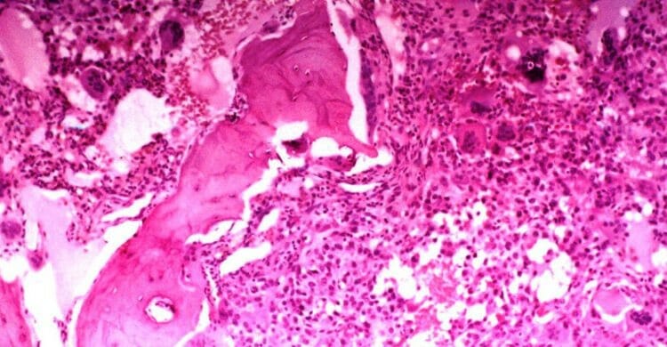 Pronostico sarcoma