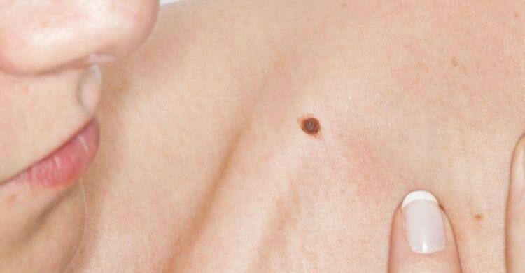 Sarcoma de tejidos blandos