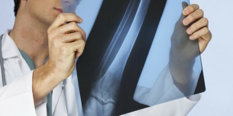 Sarcoma tejidos oseos