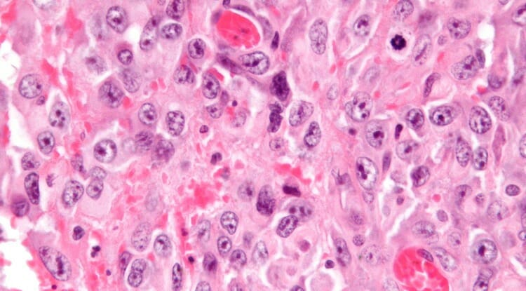 Sarcoma