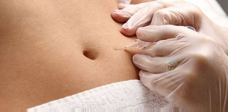 Beneficios de la carboxiterapia