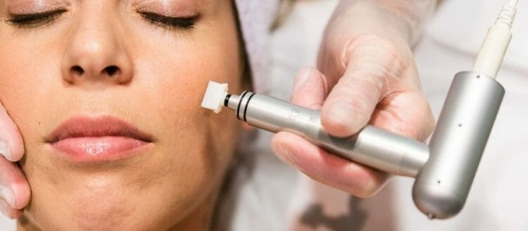 Beneficios de la dermoabrasión