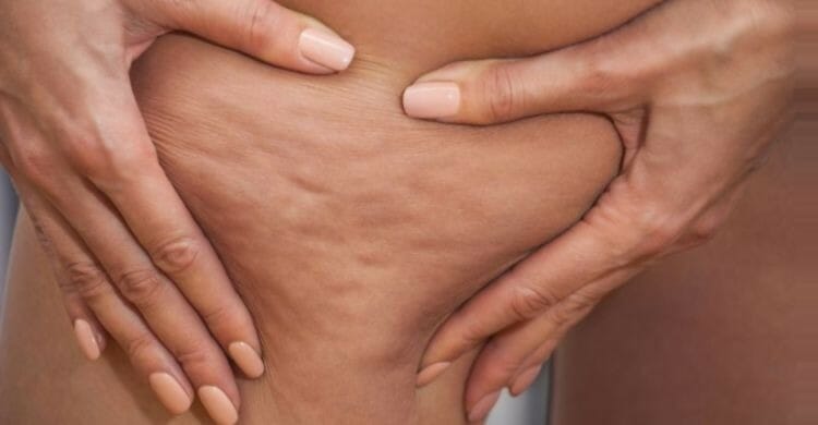 Celulitis