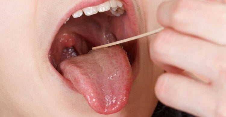 Faringitis