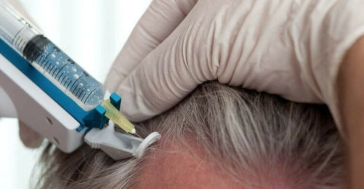 Mesoterapia para el cabello