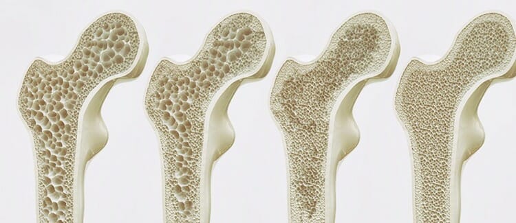 Osteoporosis