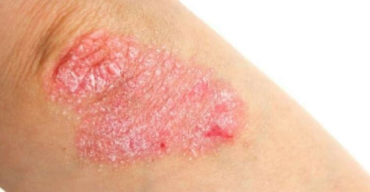 Psoriasis