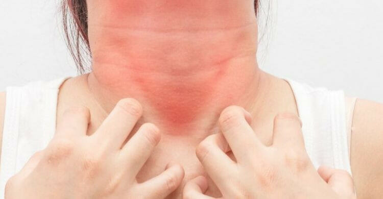 Síntomas de la alergia