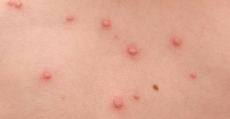 Varicela: posible causa de esta enfermedad