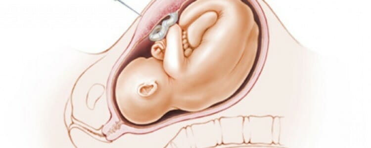 Amniocentesis