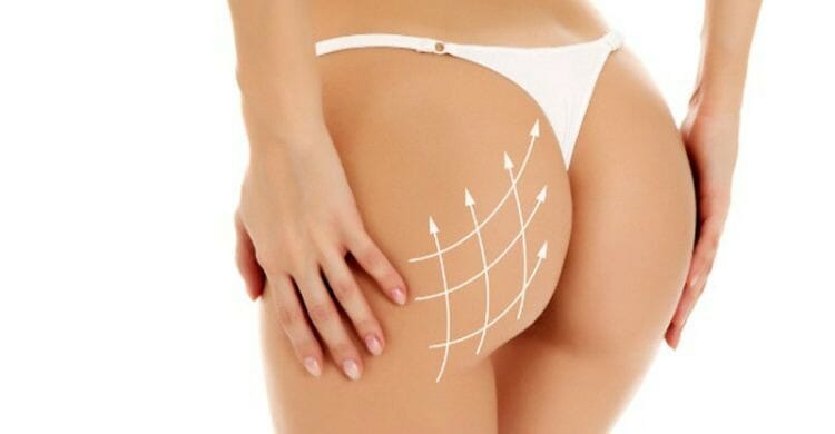 Gluteoplastia con grasa propia