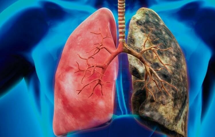 Cáncer de pulmón