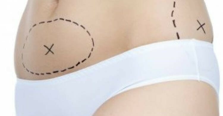 Lipoescultura VS Liposucción
