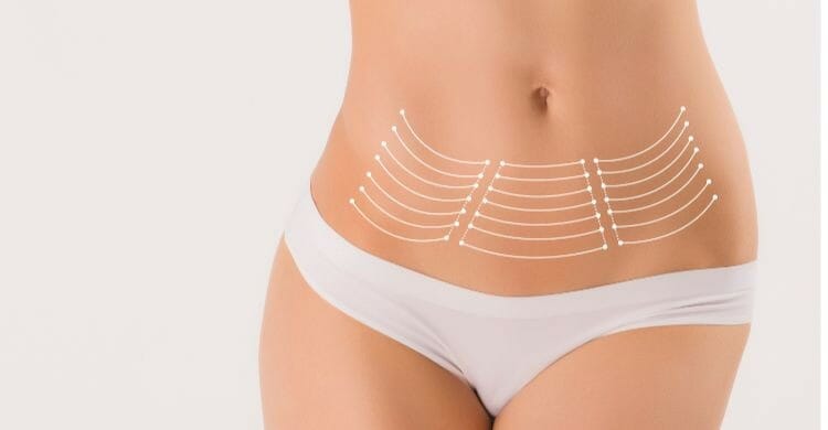 Lipoescultura