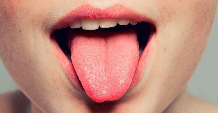 Llagas en la lengua