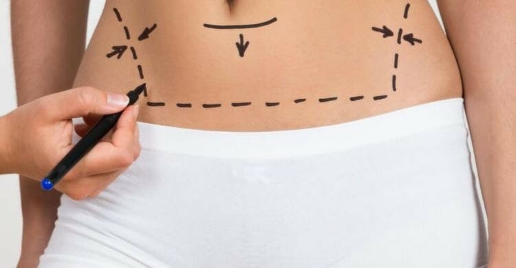 Ventajas de la lipoescultura