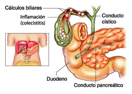 causas Barro biliar
