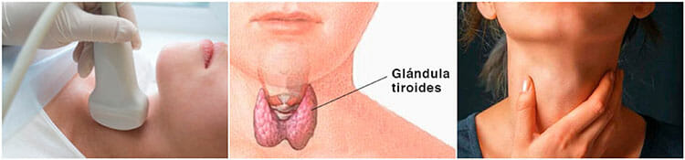 Enfermedades relacionadas con la glándula tiroides