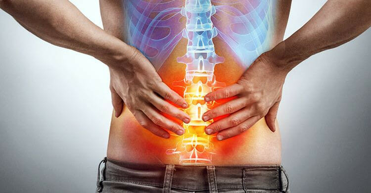¿Cómo prevenir la espondilitis anquilosante?