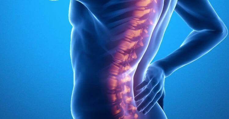 Espondilitis anquilosante: síntomas