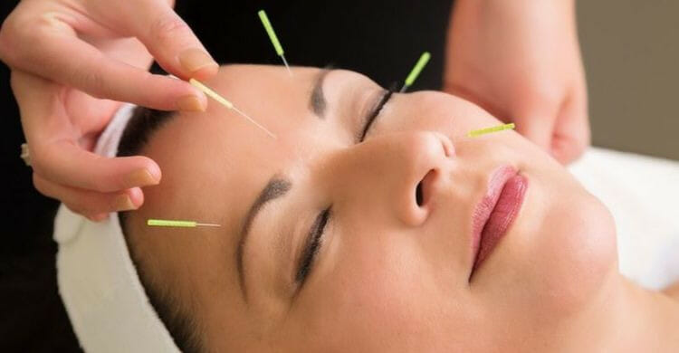 Acupuntura facial para eliminar las arrugas