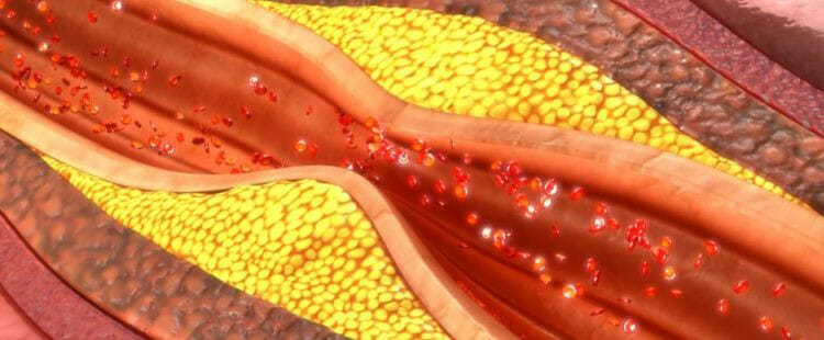 Arteriosclerosis