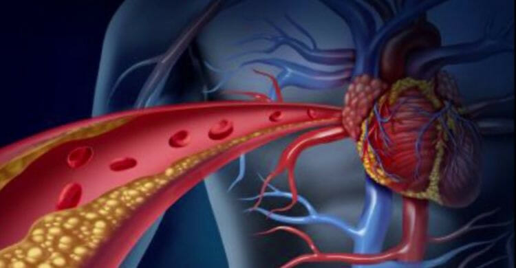 Arteriosclerosis: síntomas
