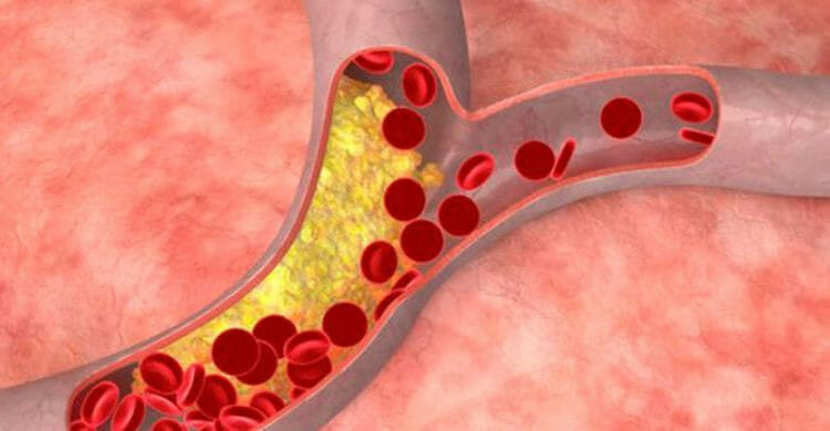 Arteriosclerosis: tratamiento