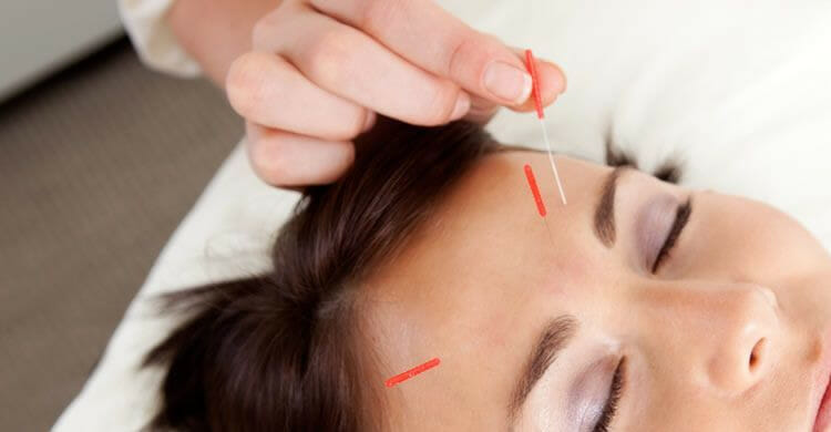 Beneficios de la acupuntura facial como tratamiento rejuvenecedor