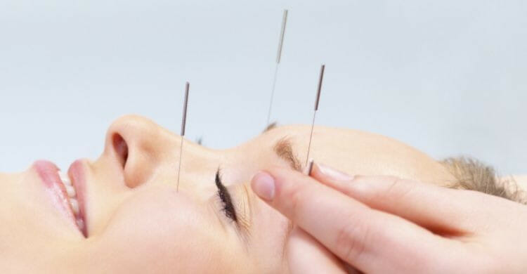 ¿Cómo son los resultados de la acupuntura facial?