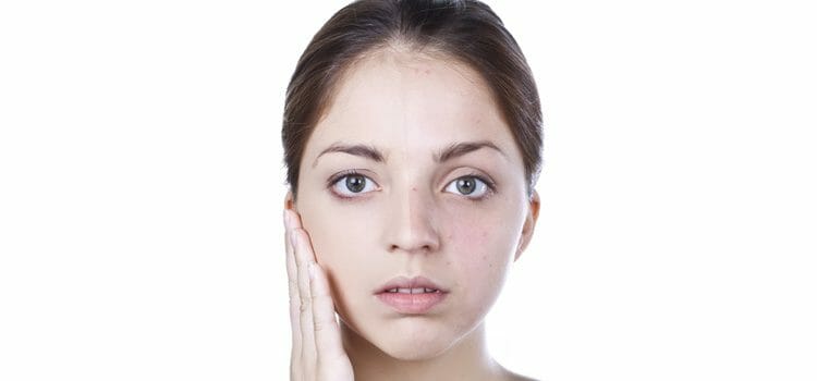 Esclerodermia o fenómeno Raynaud