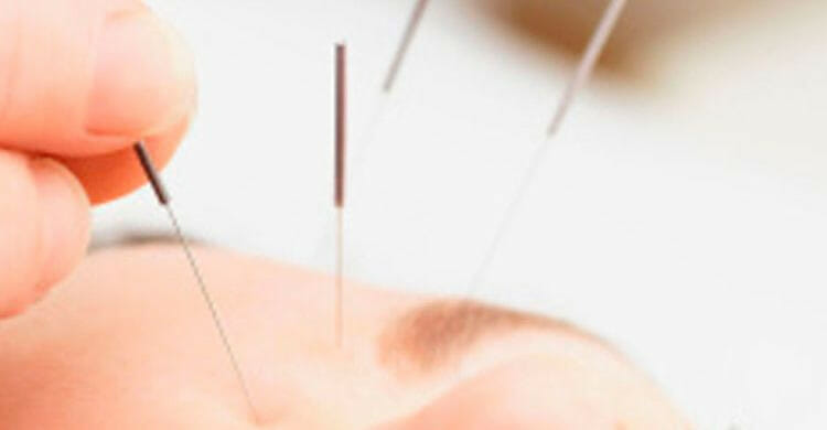 Qué es la acupuntura facial