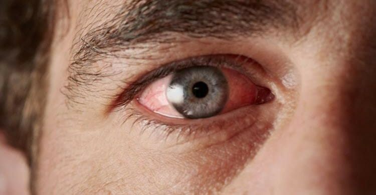 Sarcoidosis ocular