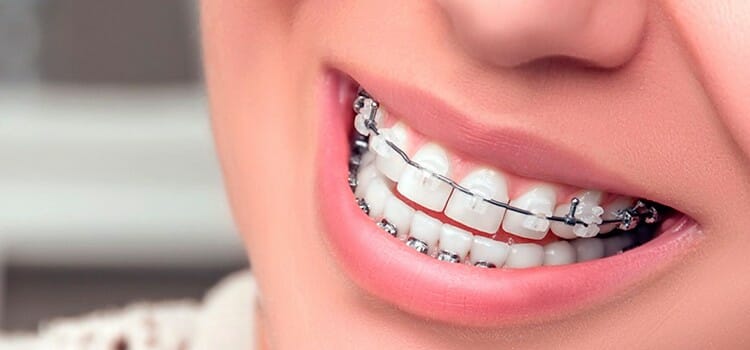 Brackets autoligados